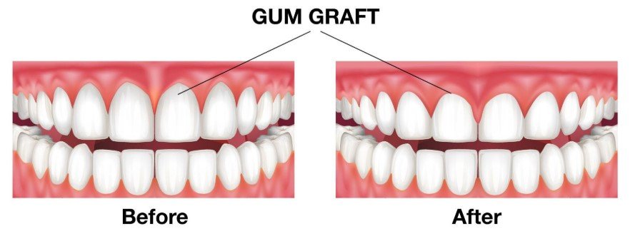 Gum Graft Before and After