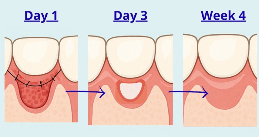 Gum Graft Healing Stages