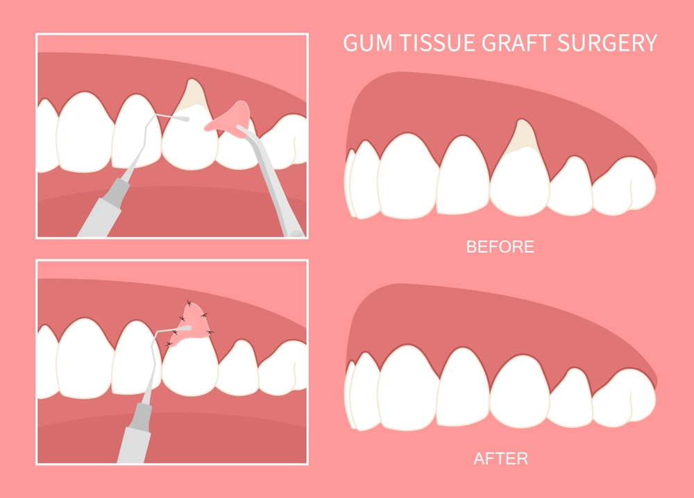 Loose Gum Flap