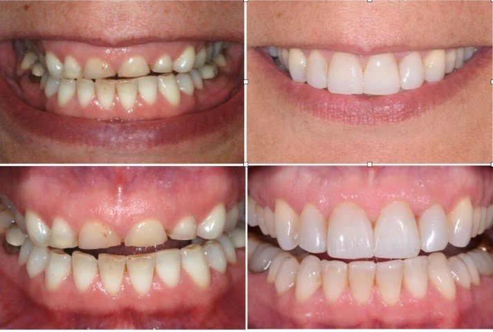 Roadblocks to a Perfect Smile