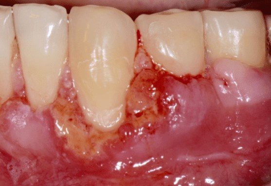 Signs of Gum Graft Failure