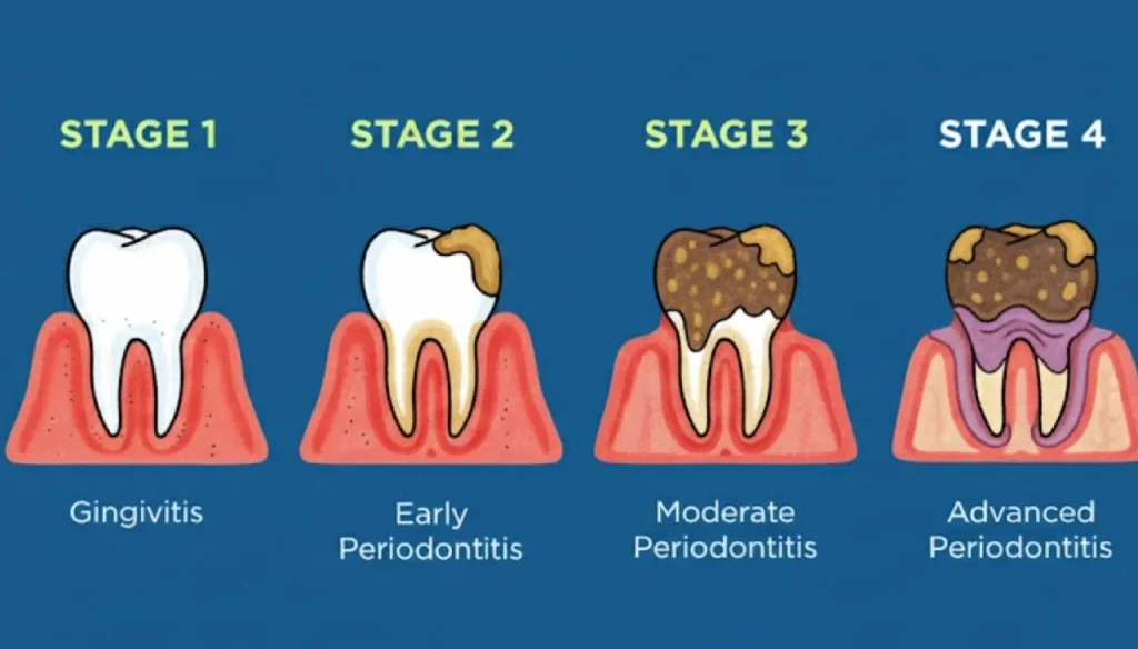 Symptoms of Gum Disease