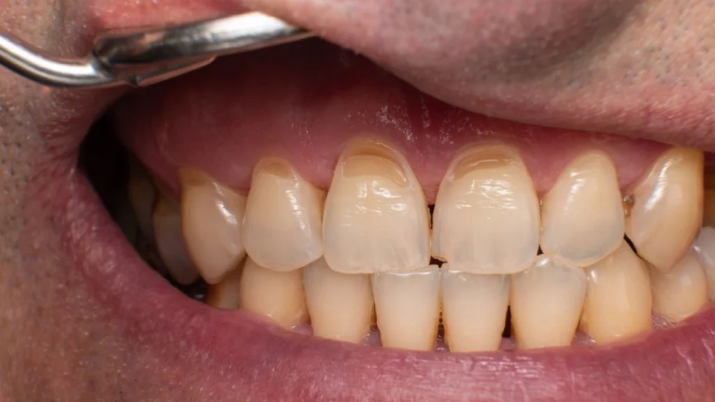 Tooth Enamel Erosion