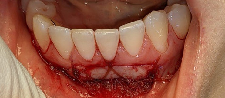 What is Gum Graft