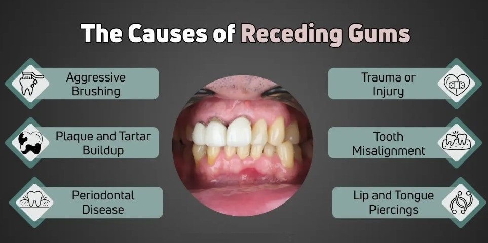 Causes of Gum Recession